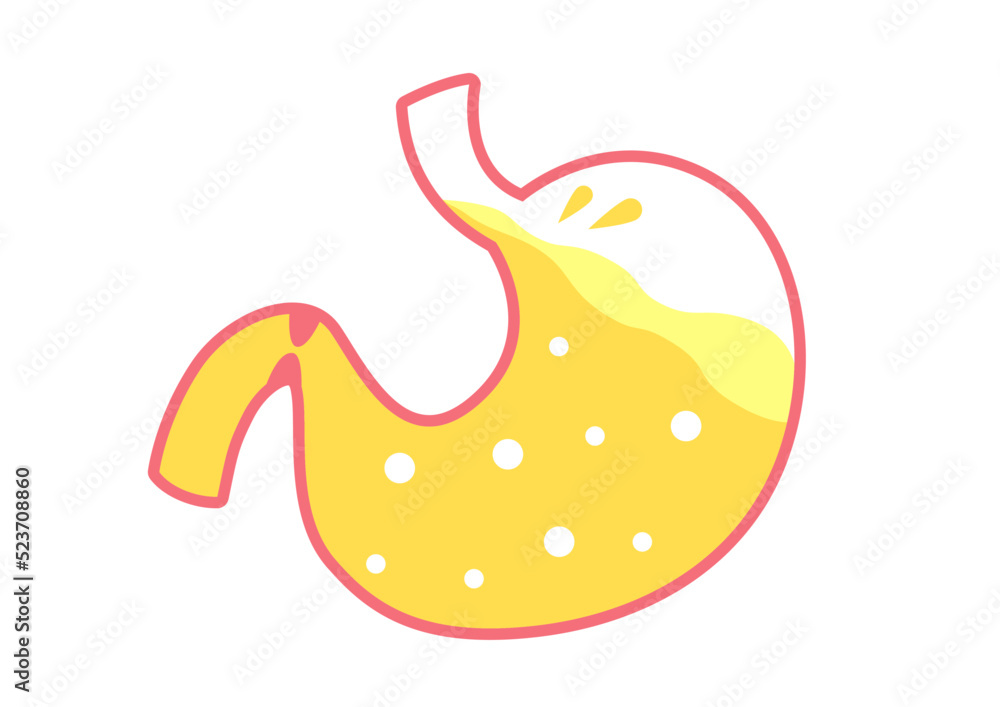 胃袋:胃液逆流 胃袋:胃液逆流