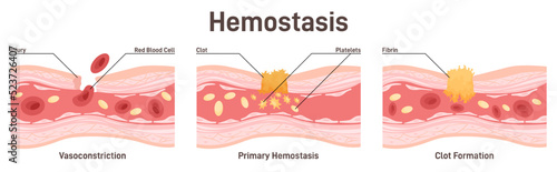 Hemostasis. Wound healing process stages, vasoconstriction and photo