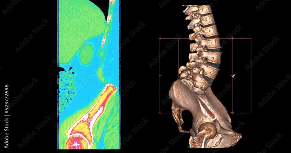 CT Scan of lumbar spine for diagnosis alck back pain diseases 3D ...