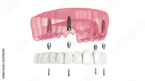 Dental prosthesis all-on-4 system supported by implants photo