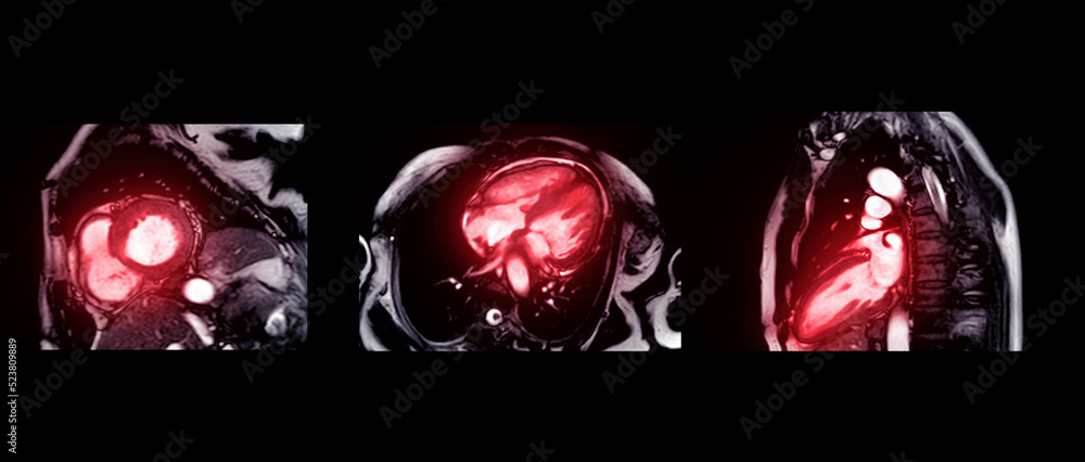 Collection of MRI heart or Cardiac MRI Stock Photo | Adobe Stock
