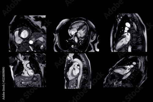 Collection of MRI heart or Cardiac MRI
