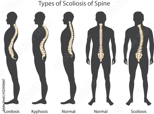 Medical poster demonstrating types of scoliosis on white background. Illustration of healthy and diseased spine