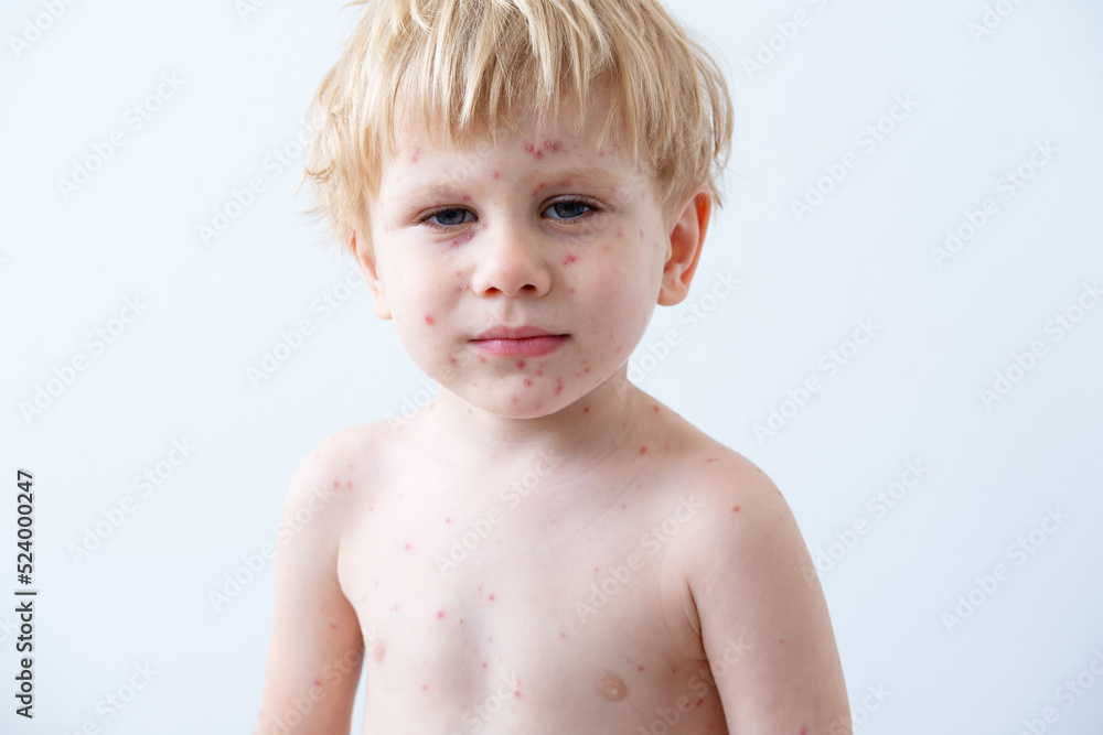 Chickenpox disease, portrait of blonde little boy with red rashes Chicken pox virus Chickenpox disease, portrait of blonde little boy with red rashes Chicken pox virus