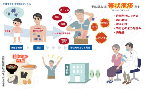 免疫機能が落ちていると発症しやすい帯状疱疹に関するイラストセット、ワクチン、ビタミンB12