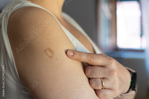 Monkeypox and smallpox vaccine concept: woman shows smallpox vaccine scar on her arm photo
