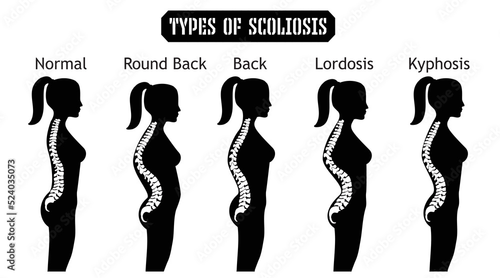 Medical Poster Demonstrating Types Of Scoliosis On White Background ...