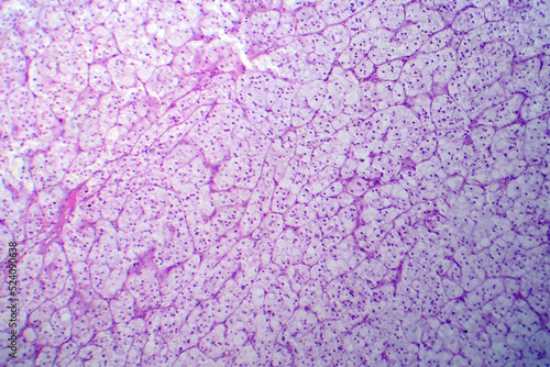 Papier peint Adrenocortical adenoma, light micrograph