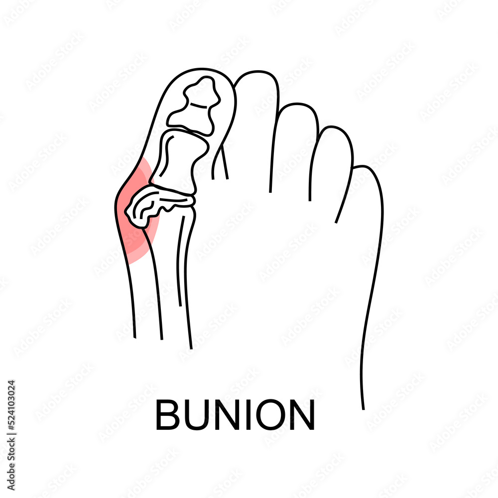 bunion-in-foot-linear-icon-abstract-minimal-illustration-of-foot-with