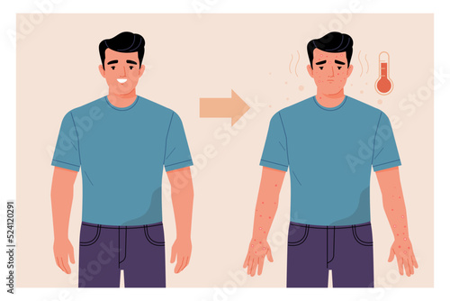 Monkeypox Virus Symptoms concept. Vector cartoon illustration of a young healthy, smiling man, and the same sad sick man with a rash on his body. Isolated on background