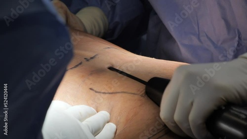 Liposuction corrective plastic surgery for liposuction of fat deposits in the abdomen. Beauty and success, crunchy body.
