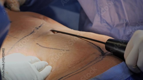 Liposuction corrective plastic surgery for liposuction of fat deposits in the abdomen. Beauty and success, crunchy body.