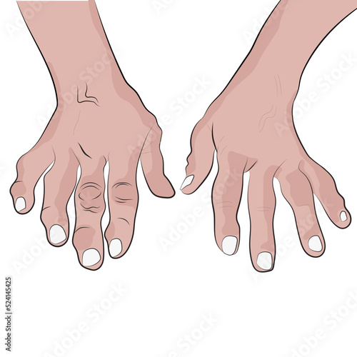 White hands with osteoarthritis, deformed hands with osteoarthritis.