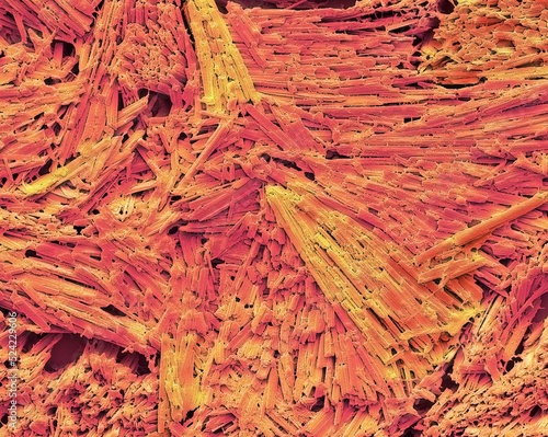 Uric acid crystals in gout, SEM photo
