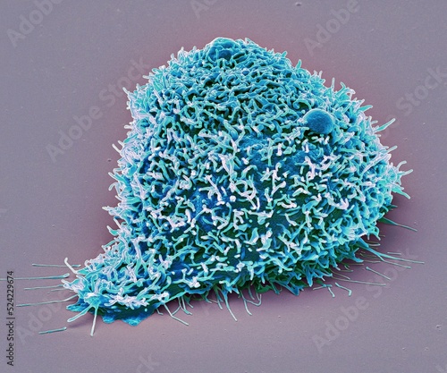 Kidney cancer cell, SEM