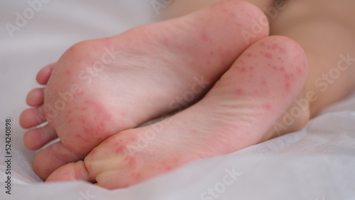 Children foot with dermatitis allergic rash closeup photo