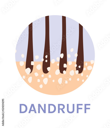 Dandruff. Close-up of Hair Follicle and Scalp. Hair Problem. Zoom. Flat Color Icon Style. White background. Vector illustration for Medical Dermatology and Beauty Design.
