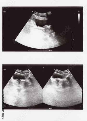 full abdomen ultrasound sonogram