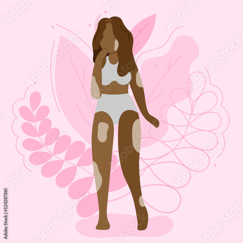 Vector illustration on the theme of body positivity. A girl with vitiligo, with long wavy hair on a background of beautiful leaves. Flat style