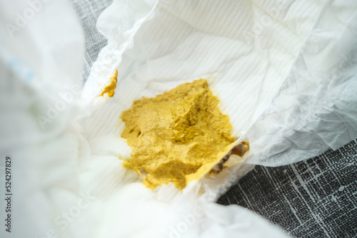 The dirty baby diaper full of sparse excrement, because the child has a diarrhea.