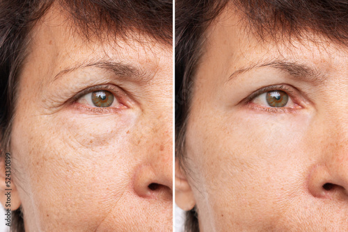 Fotografia Two shots of an elderly caucasian woman's face with puffiness under her eyes and wrinkles before and after treatment