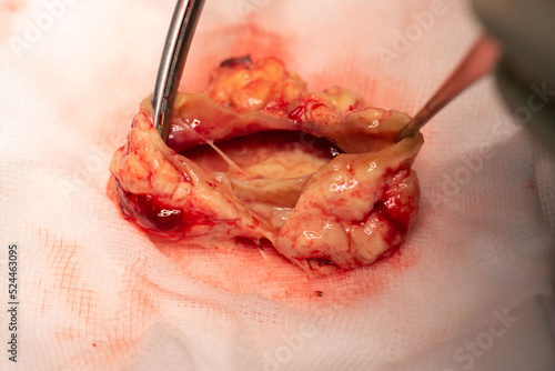 Принти на полотні Specimen of bacterial brain abscess on the table