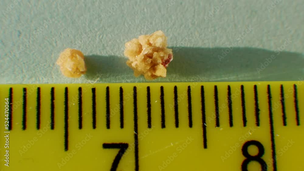 Macro shooting Oxalate stones from the human kidney close-up, measure ...