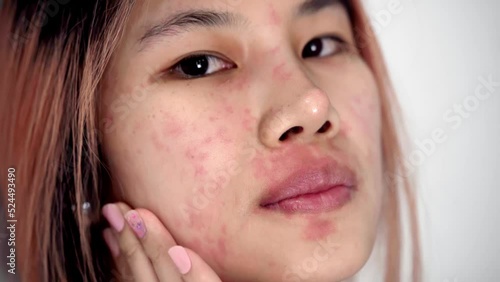 Asian woman is scratching her face from Skin Allergy infected illness. with red rash on her face.