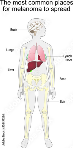 metastasis of skin cancer. malignant melanoma.