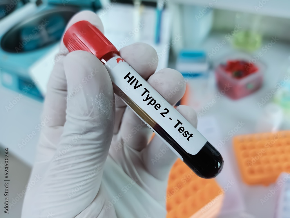 Technologist hold test tube with blood sample for HIV type 2 antibody testing, hiv screening test Technologist hold test tube with blood sample for HIV type 2 antibody testing, hiv screening test