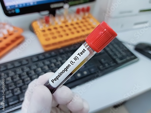 Biochemist of Scientist holds blood sample for Pepsinogen (I,II) test, diagnosis for early detection of gastric cancer. PG I, PG II. Medical test tube in laboratory background.