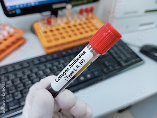 Biochemist of Scientist holds blood sample for collagen antibody (I, II, IV) test, to diagnose liver disease. Medical test tube in laboratory background.