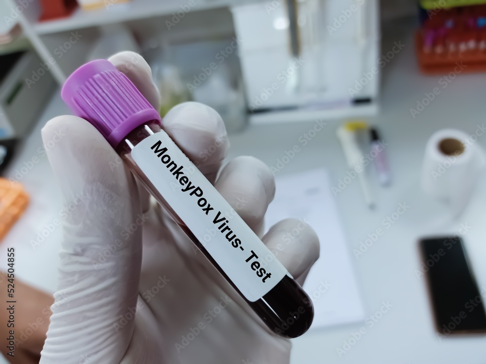 Biochemist of Scientist holds blood sample for Monkeypox virus test. A double stranded DNA virus and member of Poxviridae family.