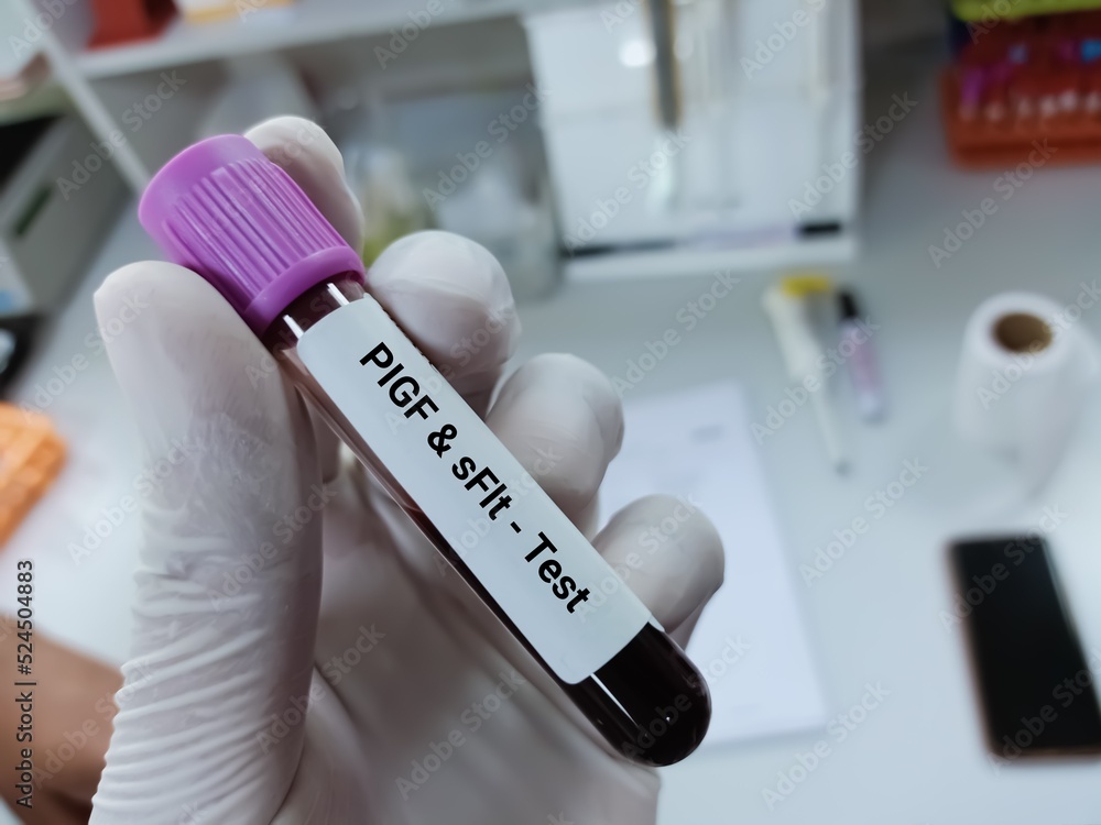 Biochemist of Scientist holds blood sample for  placental growth factor or PIGF and Soluble fms-like tyrosine kinase or sFLT test. Medical test tube in laboratory background.