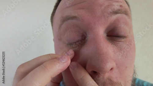 Eye disease red eyes conjunctivitis a man with a beard looks at the camera checks his eye. High quality 4k footage