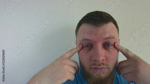 Eye disease red eyes conjunctivitis a man with a beard rubs his eyes scratches on the background of the wall. High quality 4k footage