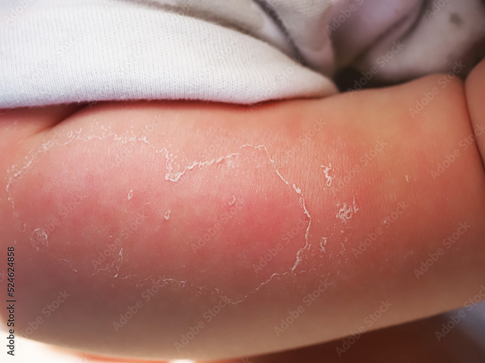Red hand kid baby skin close up sunburn from sun. peeling of the skin on the arm of a child Red hand kid baby skin close up sunburn from sun. peeling of the skin on the arm of a child