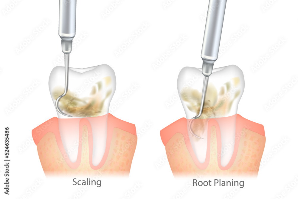 Difference of the Periodontal Scaling and Root Planing. Oral hygiene and conventional