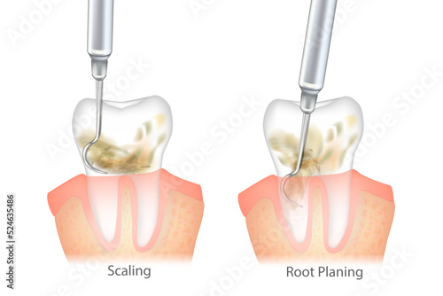 Difference of the Periodontal Scaling and Root Planing. Oral hygiene and conventional periodontal therapy. Medically accurate of human teeth cleaning treatment. Dental scale. photo