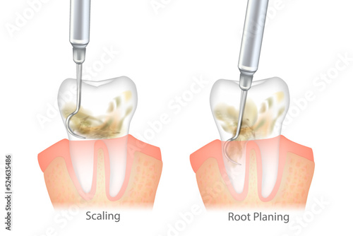Difference of the Periodontal Scaling and Root Planing. Oral hygiene and conventional periodontal therapy. Medically accurate of human teeth cleaning treatment. Dental scale.
