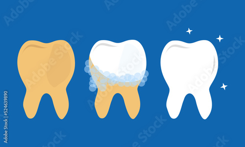 Tooth before and after whitening infographic elements. Teeth whitening concept. oral hygiene. vector illustration.