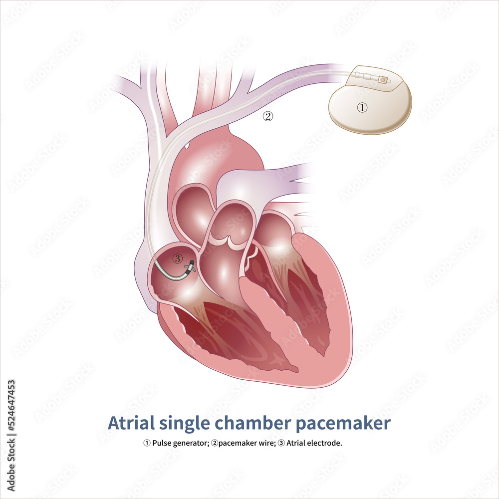 Atrial single chamber pacemakers have only one electrode placed in the
