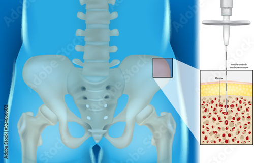 Bone Marrow Aspiration And Biopsy. Illustration of the Needle extends into bone marrow. Hematology