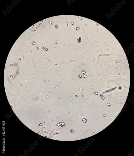 Microscopic image showing Calcium oxalate (monohydrate and dihydrate) crystals from urine sediment, most common cause of kidney stones.