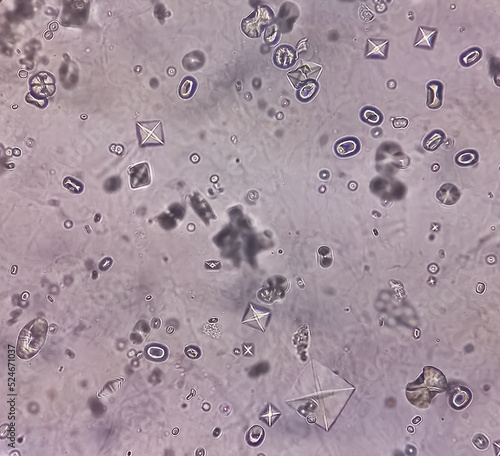 Fotografia Microscopic image showing Calcium oxalate (monohydrate and dihydrate) crystals from urine sediment, most common cause of kidney stones