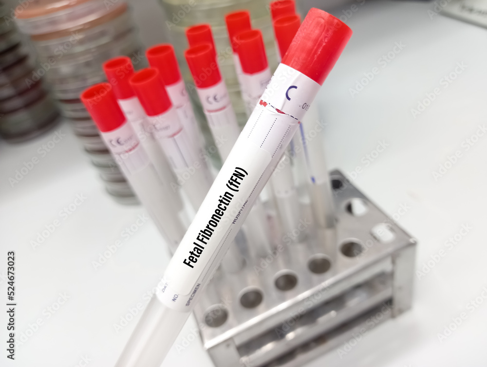 Fetal fibronectin test sample collect from border of amniotic sac of ...