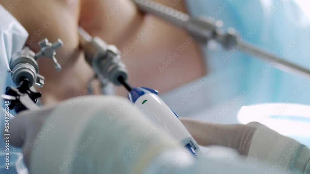 Hands of surgeons with the help of endoscopic equipment and instruments