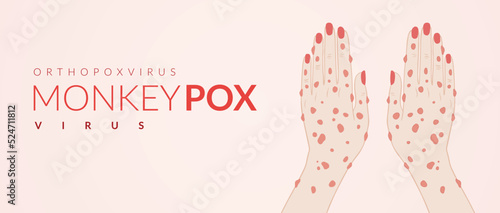 Monkeypox virus banner for awareness and alert against disease spread, Hand rash with monkeypox. Monkey Pox virus outbreak pandemic, pidemic from animals to humans. Monkeypox virus background