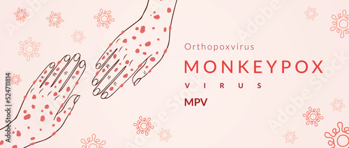 Monkeypox virus banner for awareness and alert against disease spread, Hand rash with monkeypox. Monkey Pox virus outbreak pandemic, pidemic from animals to humans. Monkeypox virus background photo