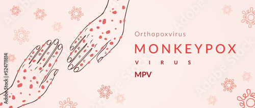 Monkeypox virus banner for awareness and alert against disease spread, Hand rash with monkeypox. Monkey Pox virus outbreak pandemic, pidemic from animals to humans. Monkeypox virus background